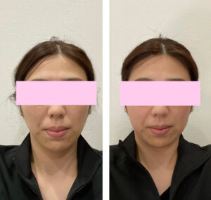 小顔になる施術を3回受けた様子